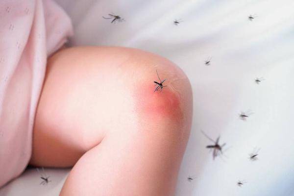 蚊子咬止癢方法